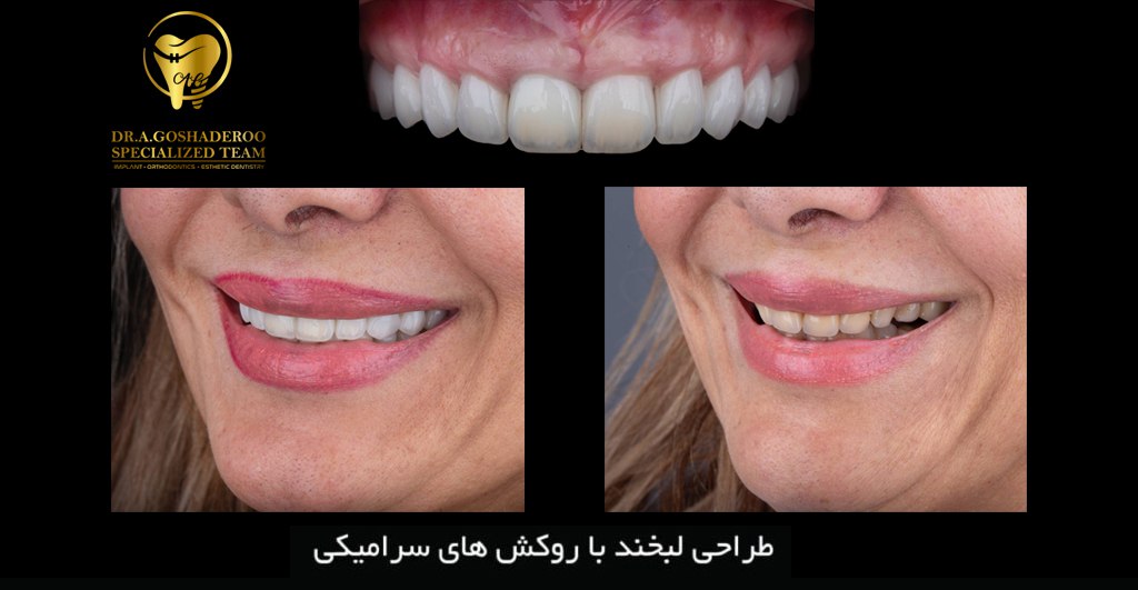 طراحی لبخند با روکش سرامیکی