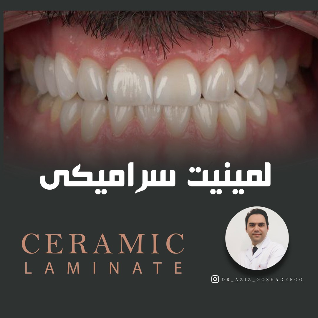 لمینیت سرامیکی دندان _ طراحی لبخند زیبا