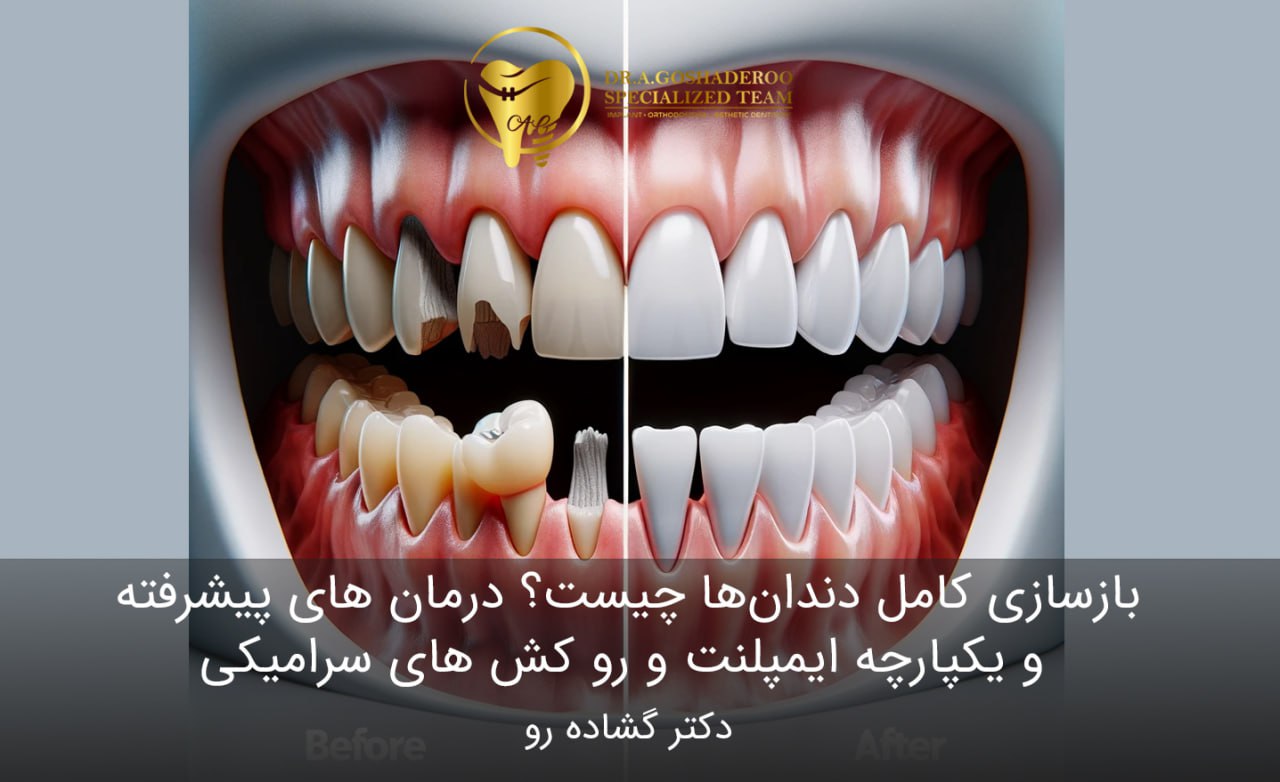 بازسازی کامل دندان‌ها چیست؟