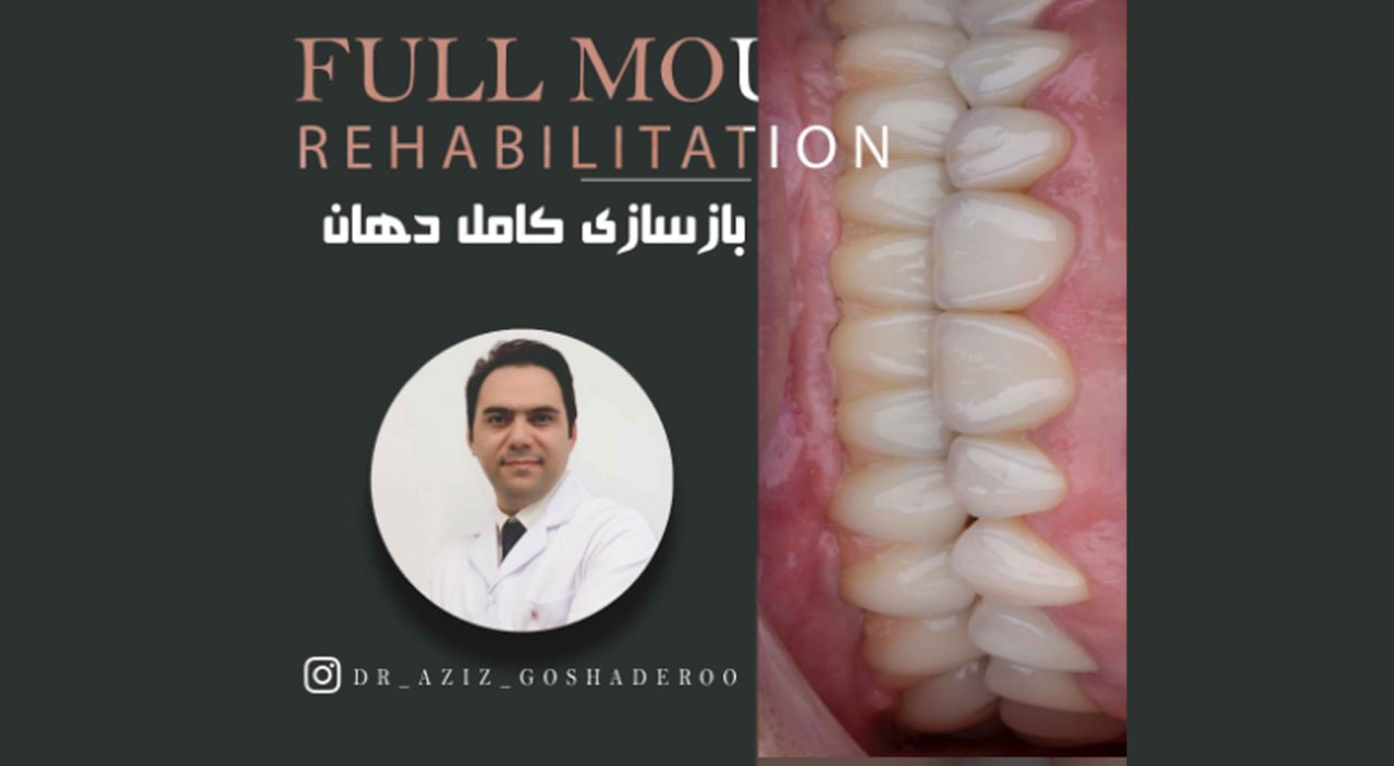 بازسازی کامل دهان _ نمونه درمان