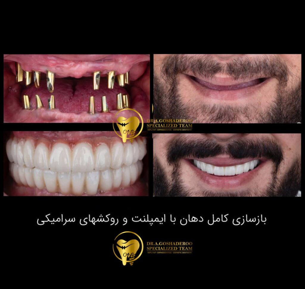 ایمپلنت فوری
