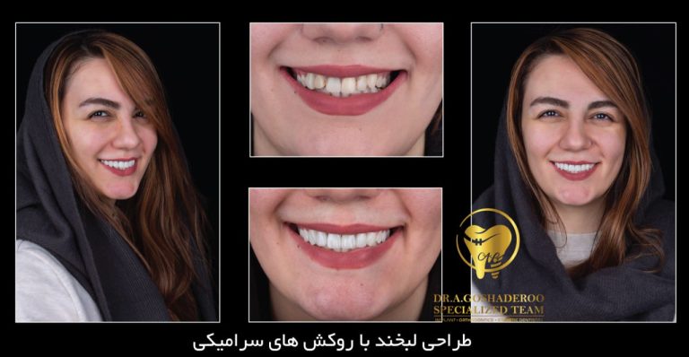 کامپوزیت دندان