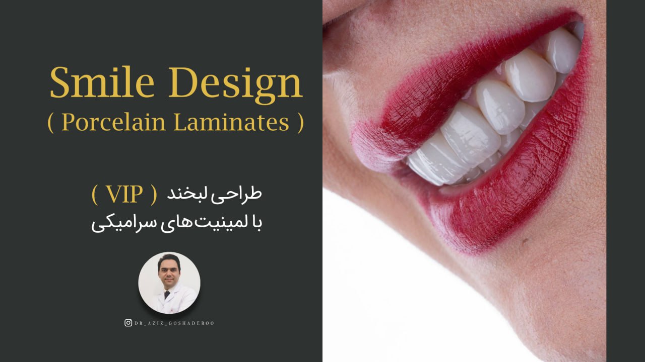 طراحی لبخند (VIP)با لمینیت های سرامیکی