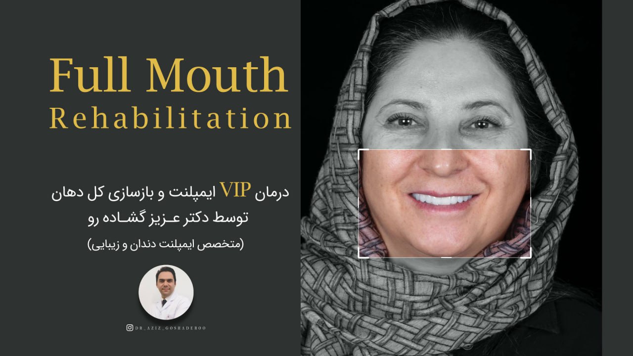 نتیجه درمان(VIP) ایمپلنت و بازسازی کل دهان
