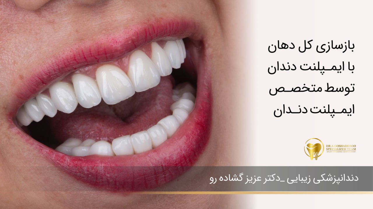بازسازی کل دهان با ایمپلنت دندان توسط متخصص ایمپلنت دندان