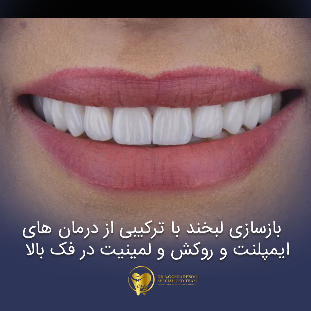بازسازی لبخند با ترکیبی از درمانهای ایمپلنت و روکش و لمینیت