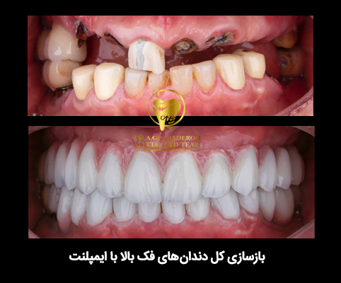 عمل جراحی کاشت ایمپلنت دندان