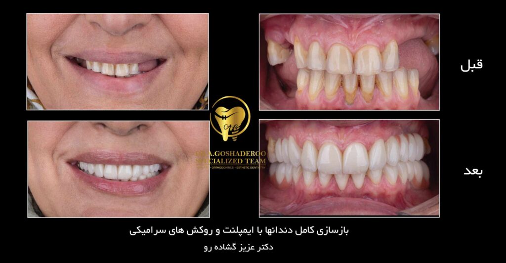 بازسازی کامل دهان با ایمپلنت و روکش های سرامیکی