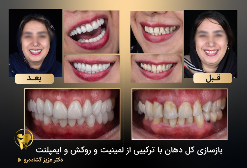 تعویض کامپوزیت با لمینت&zwnj;