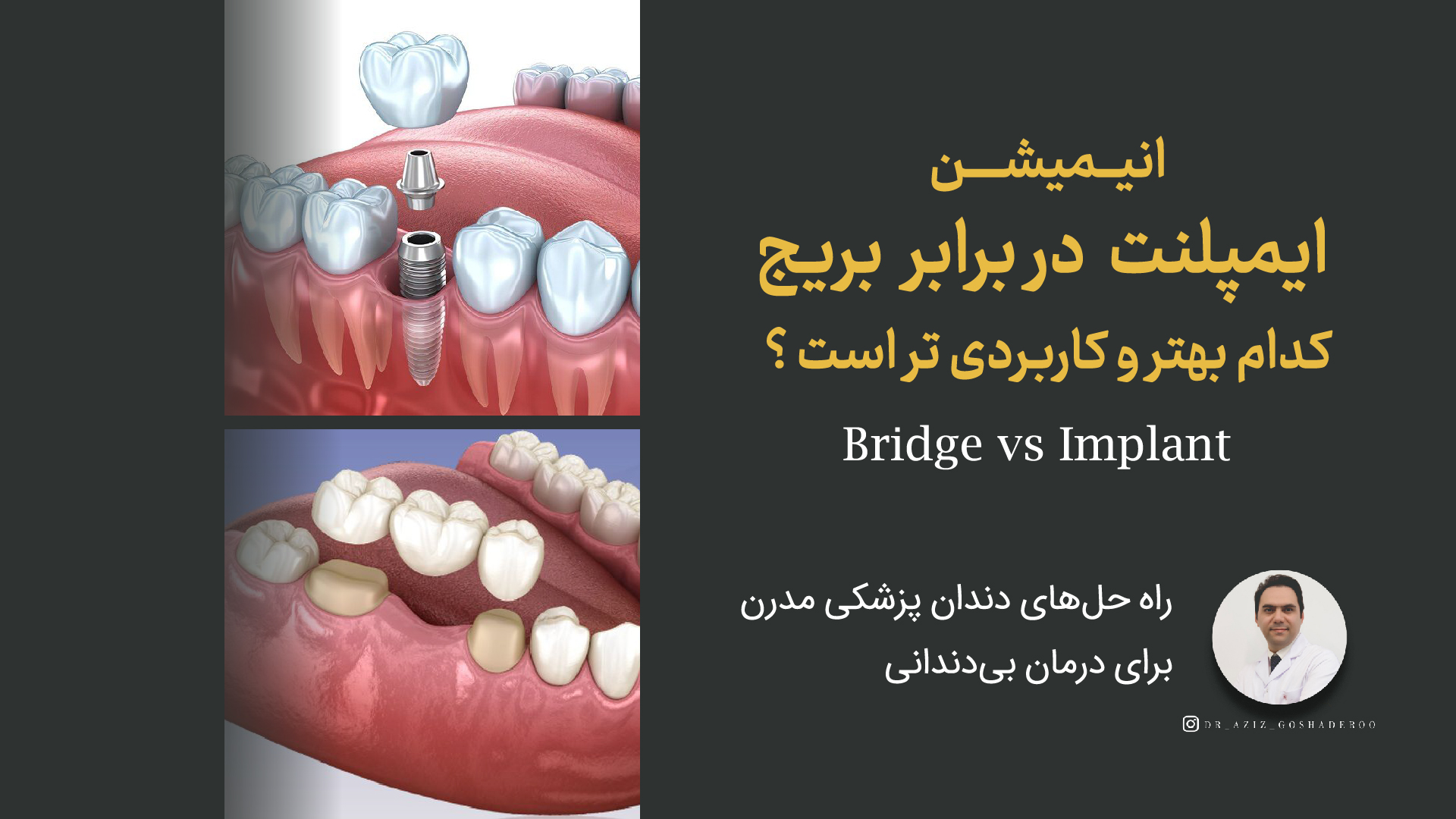 انیمشن ایمپلنت در برابر بریج کدام بهتر و کاربردی تر است ؟