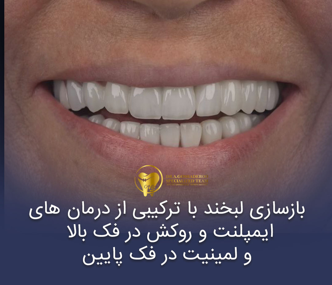 بازسازی لبخند با ترکیبی از درمان های ایمپلنت و روکش