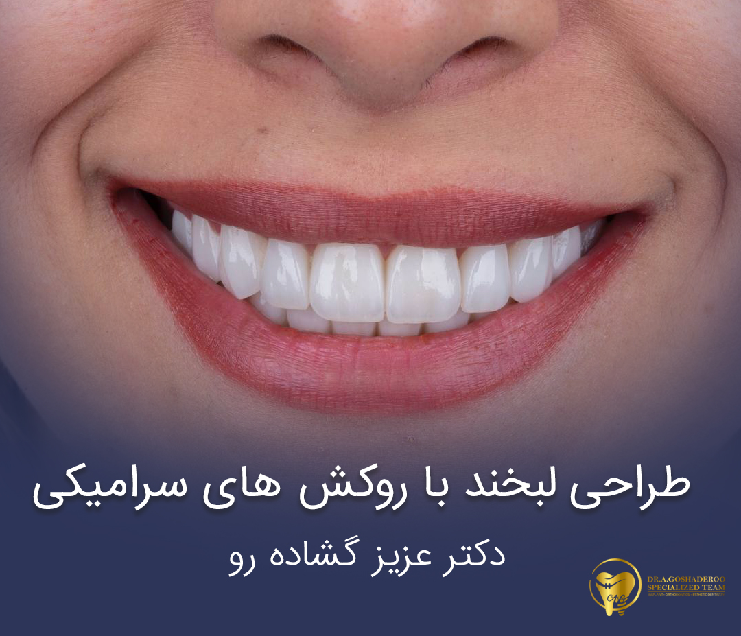 اصلاح طرح لبخند با روکش های سرامیکی