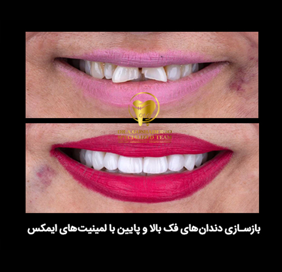 بازسازی دندان با روکش ایمکس
