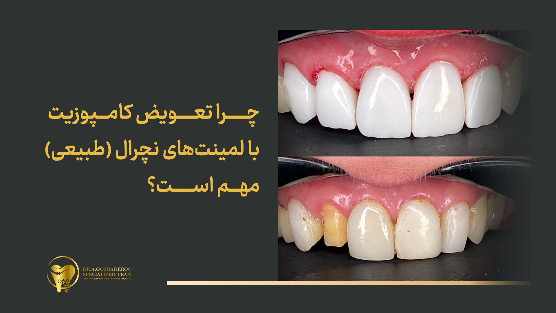 چرا تعویض کامپوزیت با لمینت‌های نچرال (طبیعی) مهم است؟